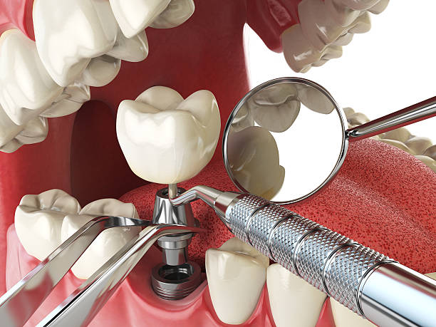 Best Emergency Root Canal Treatment in Iona, FL